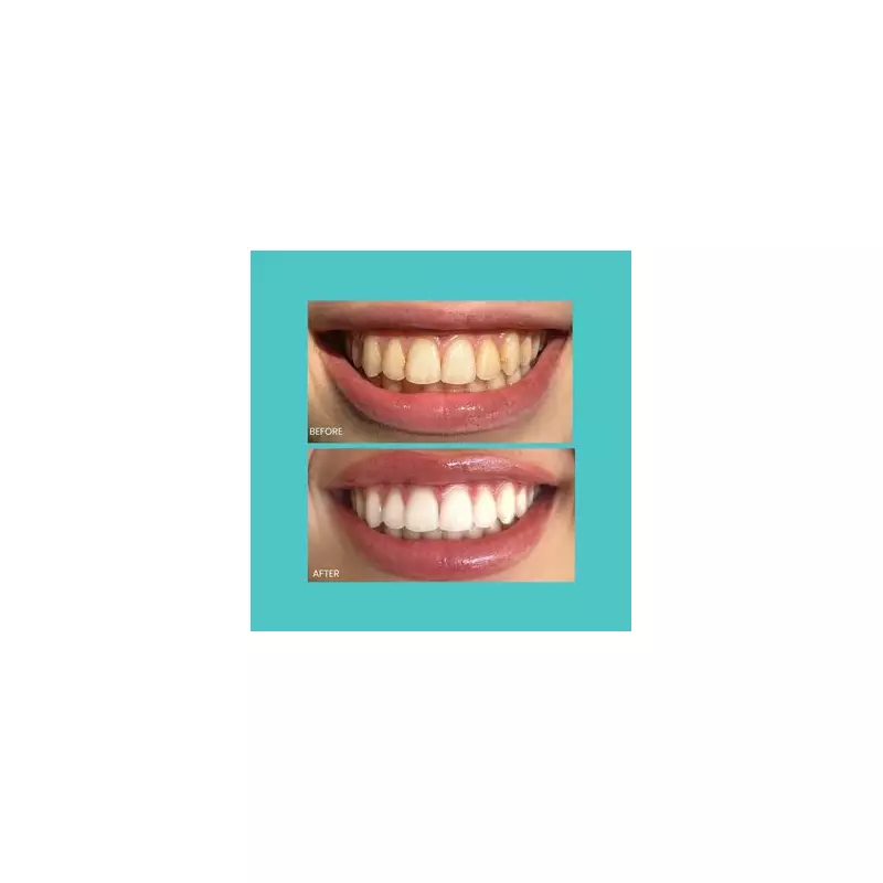 Black Friday Deal: Smilie Teeth Whitening Kit Dazzles at 70% Off