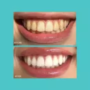 Black Friday Deal: Smilie Teeth Whitening Kit Dazzles at 70% Off