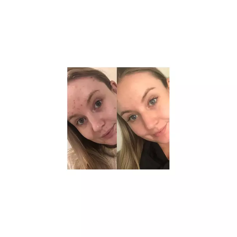 Acne Hack: The £1.50 Spot Treatment That's Going Viral