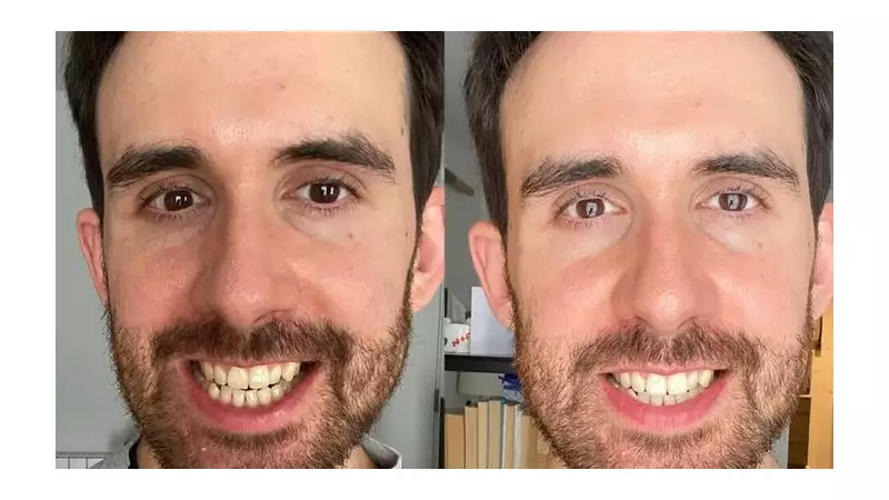 Festive Smile Boost: Teeth Whitening Strips Slashed to Under £10