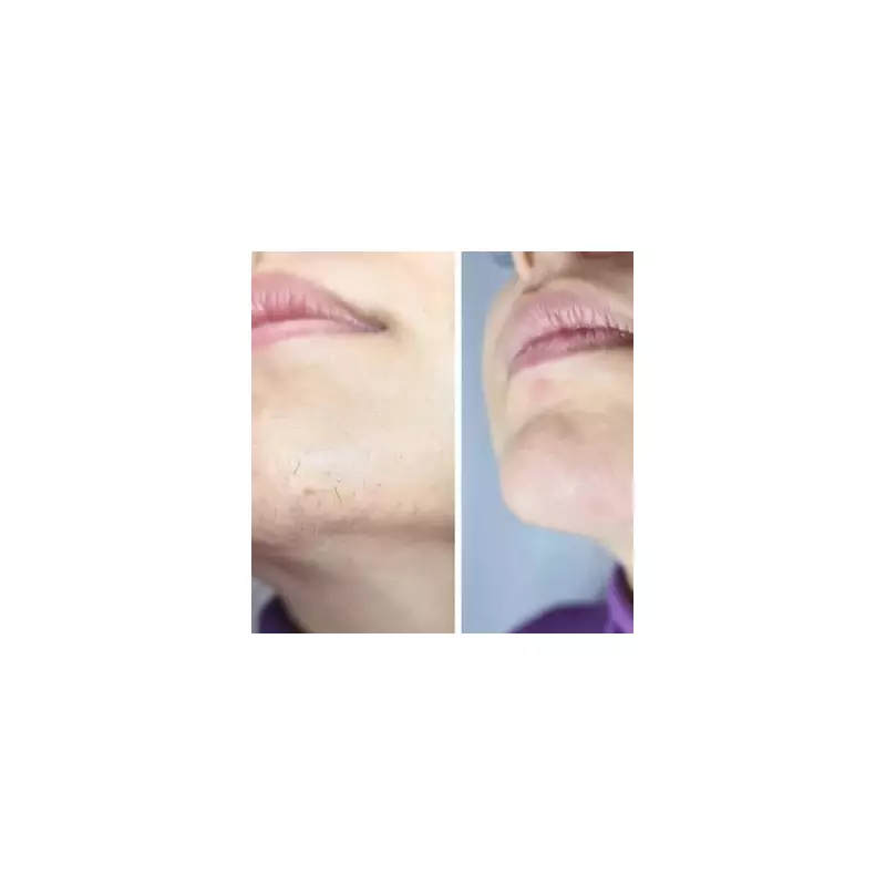 Keskine IPL Handset £140 Off: 'Best Hair Removal' Reviews & Black Friday Deal