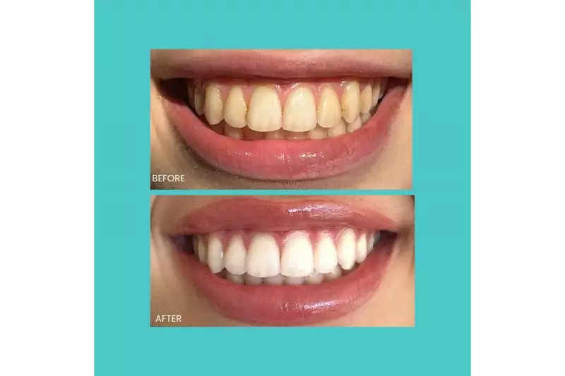 Last Chance: £55 Smilie Whitening Deal Ends Tonight at Midnight