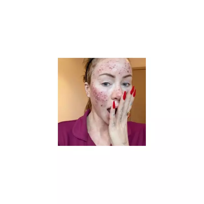 Olivia Attwood's Bloodied Face After CO2 Laser Treatment Alarms Fans