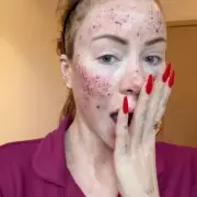 Olivia Attwood's Bloodied Face After CO2 Laser Treatment Alarms Fans