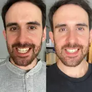 Teeth Whitening Strips Slashed to £9.99 for Festive Season