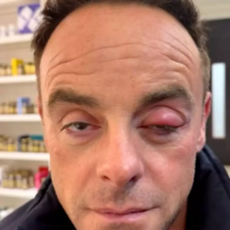 Ant McPartlin's Eye Swelling Drama: TV Star Reveals Blocked Tear Duct