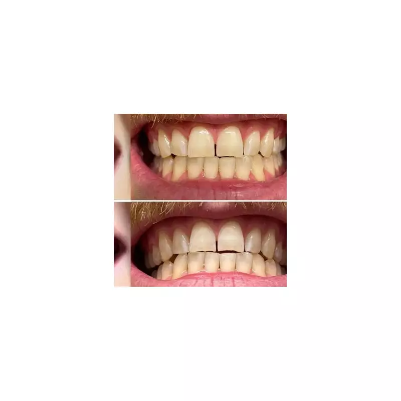 Science-Backed £20 Teeth Whitening Strips Brighten Smiles by 10 Shades