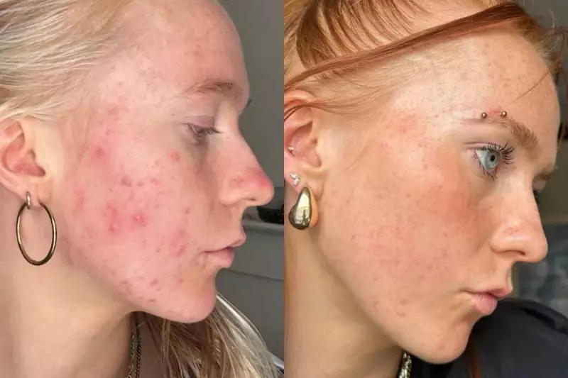 Winter Skin Woes: The Dermatologist-Approved Two-Step Solution