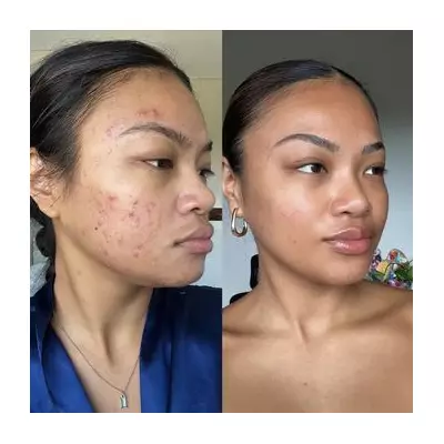 Boots £11 Spot Cream Sparks 'Wow' Face Transformations for Acne-Prone Skin