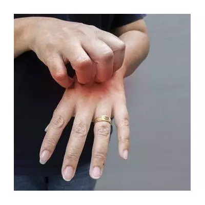 Poinsettia Warning: Popular Festive Plant Can Cause Painful Skin Rashes