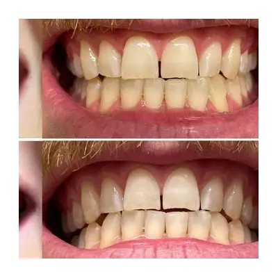 Science-Backed £20 Teeth Whitening Strips Brighten Smiles by 10 Shades