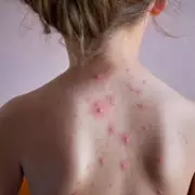 Chickenpox Vaccine Added to NHS Childhood Programme: New MMRV Jab Rollout