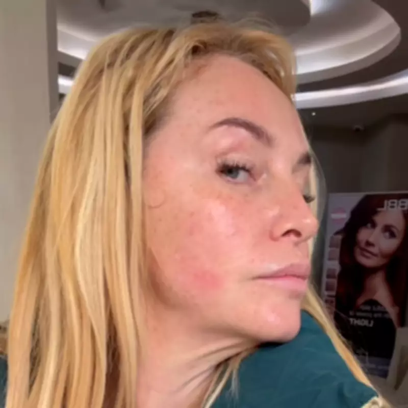 Josie Gibson's Anti-Aging Laser Treatment Wows Fans with Transformation