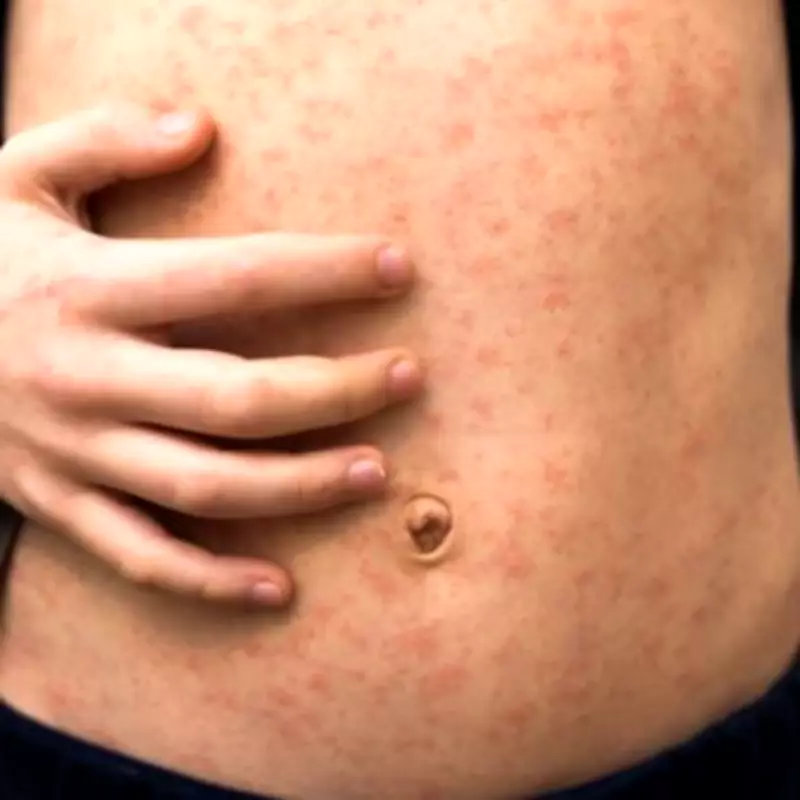 Measles Outbreak Hospitalizes Children in London Schools