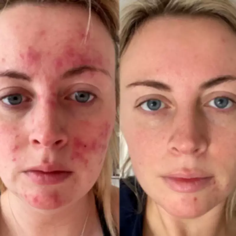 Skincare Breakthrough Transforms Dating Confidence for Acne Sufferers