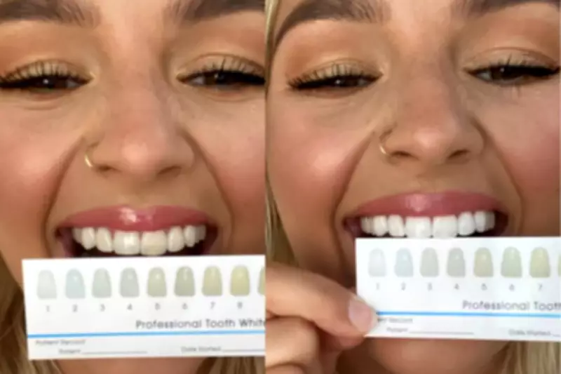 SmilePro Teeth Whitening Kit Review: A Home Whitening Transformation