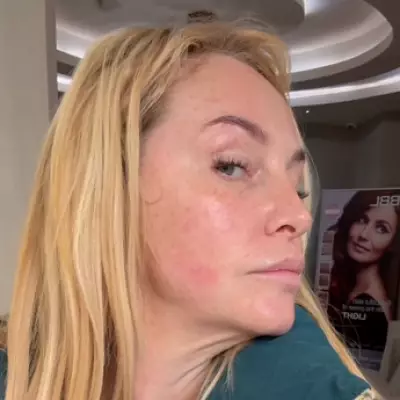 Josie Gibson's Anti-Aging Laser Treatment Wows Fans with Transformation