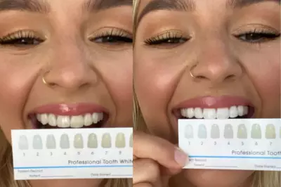 SmilePro Teeth Whitening Kit Review: A Home Whitening Transformation