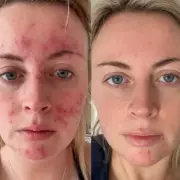 Skincare Breakthrough Transforms Dating Confidence for Acne Sufferers