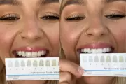 SmilePro Teeth Whitening Kit Review: A Home Whitening Transformation