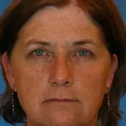 Smoking Twin Study Reveals Dramatic Ageing Gap in Identical Siblings