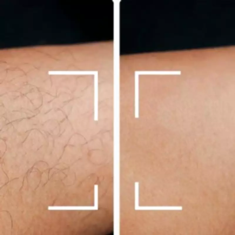 Keskine IPL Device Slashes Hair Removal Costs by Thousands with £140 Discount