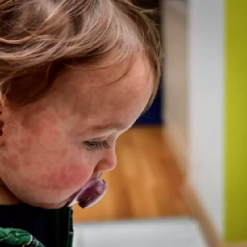 Measles Outbreak Surges in Birmingham as Victorian Disease Makes Alarming Return