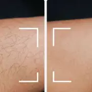 Keskine IPL Device Slashes Hair Removal Costs by Thousands with £140 Discount