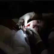Birmingham Children's Teeth Crisis: Some Kids Need 15 Extractions