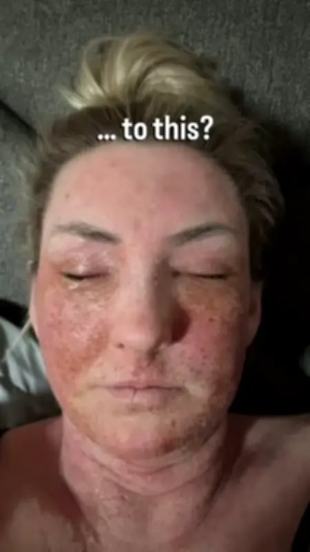 Birmingham Teacher Left 'Looking Like a Burnt Hamster' After Eczema Cream Withdrawal