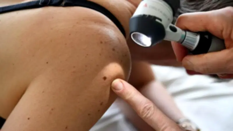 Doctors Warn: Skin Cancer Signs Beyond Moles Often Overlooked