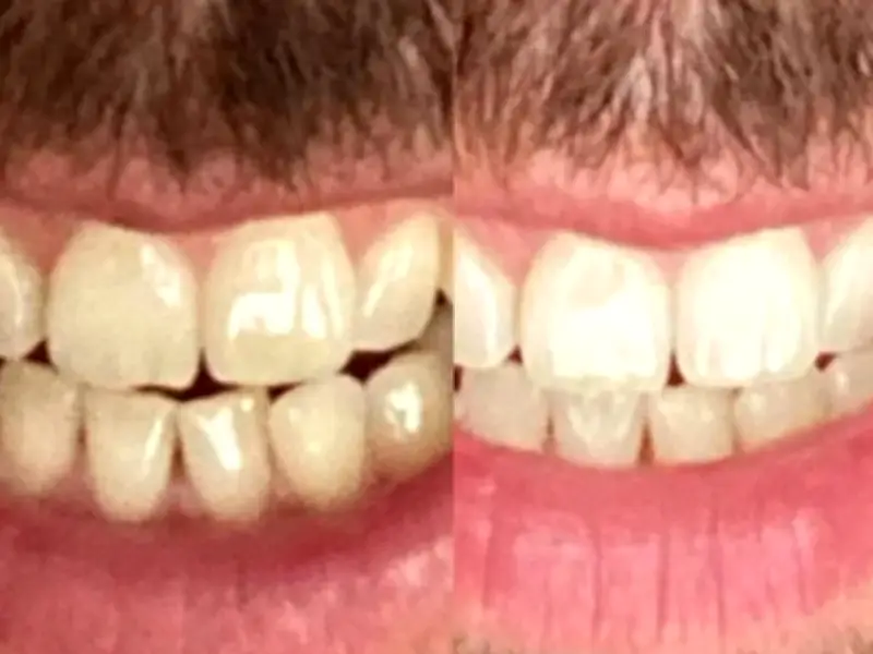 Man, 66, says £10 powder removed coffee and beer stains from teeth