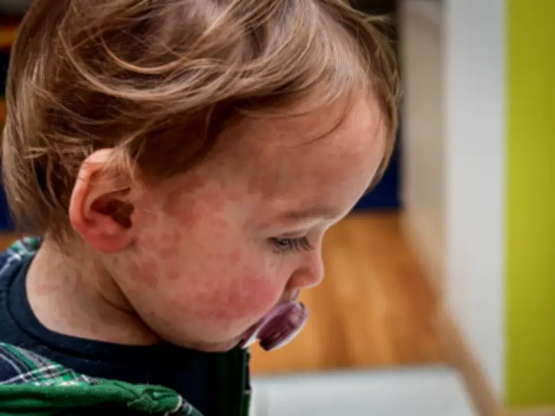 Measles Cases Surge in West Midlands: Urgent MMR Jab Plea Issued