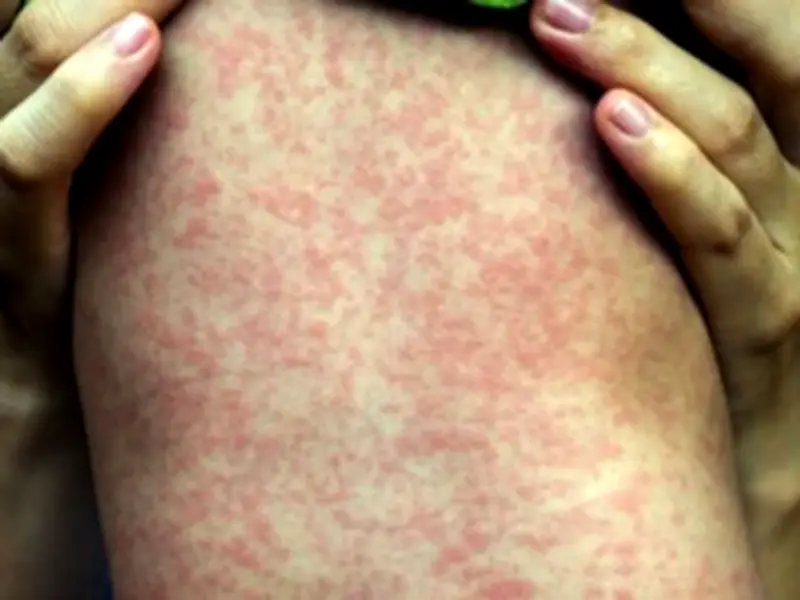 Measles Outbreak Kills Two Children, 106 New Cases in Two Weeks