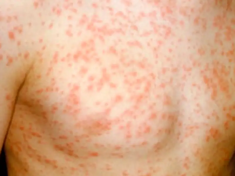 Measles outbreak mapped: 106 new cases, two children die in England