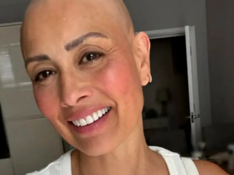 Melanie Sykes Shares Bold Bald Head Photo Amid Alopecia Battle