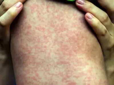 Measles Outbreak Kills Two Children, 106 New Cases in Two Weeks