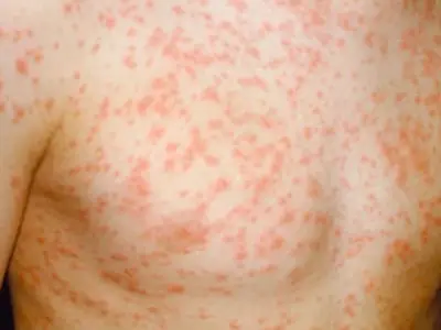 Measles outbreak mapped: 106 new cases, two children die in England