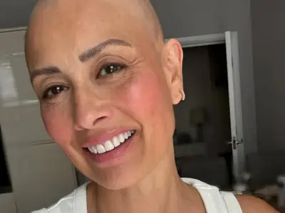 Melanie Sykes Shares Bold Bald Head Photo Amid Alopecia Battle