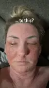 Birmingham Teacher Left 'Looking Like a Burnt Hamster' After Eczema Cream Withdrawal