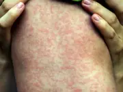 Measles Outbreak Kills Two Children, 106 New Cases in Two Weeks