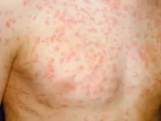 Measles outbreak mapped: 106 new cases, two children die in England