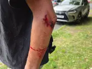 Harborne Man Bitten by Escaped Dog in Attack; Police Seize Three Dogs